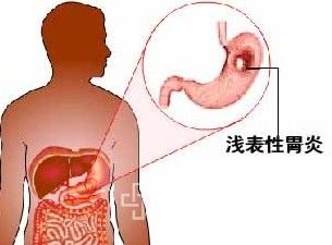 浅表性胃炎的预防方法
