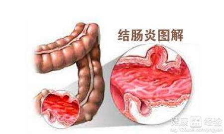 结肠炎症状