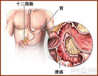 十二指肠溃疡并发症