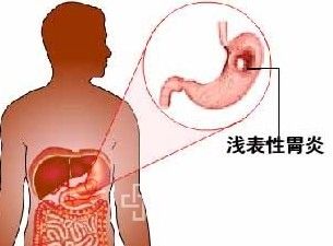 胃炎