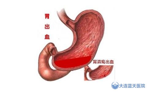 胃出血