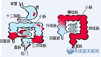 肠息肉