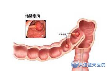 结肠息肉
