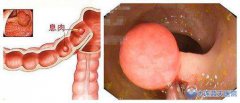 胃息肉的胃镜检查