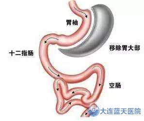胆汁反流性胃炎的治疗方法