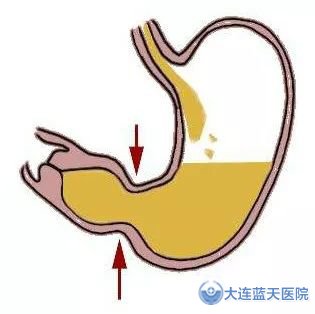 大连胃肠科医院专家告诉您：反流性胃炎发作时该如何缓解！