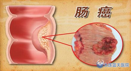 大连胃肠科医院：“便血”请别忽略！