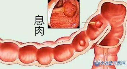 大连胃肠科医院：“便血”请别忽略！